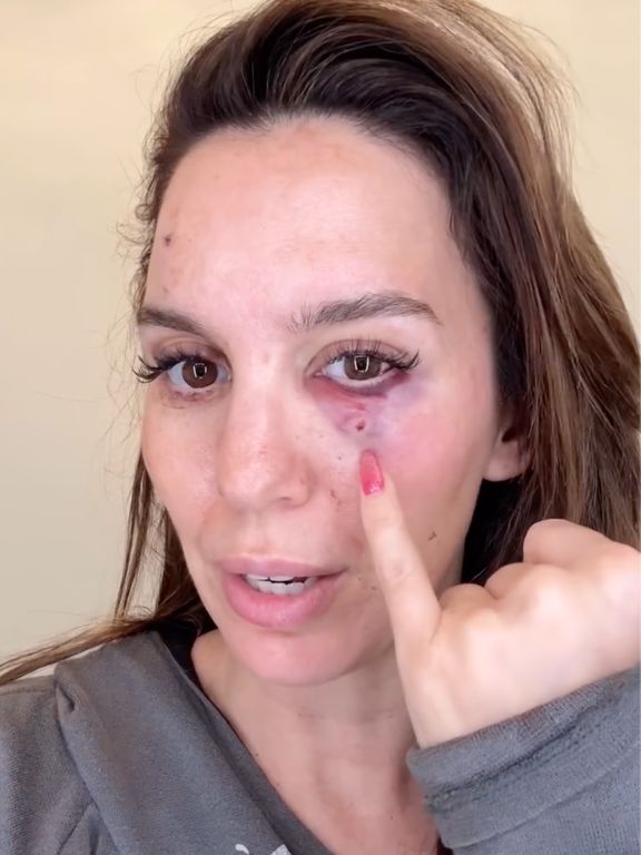 Christy Carlson Romano Shot in the Eye While Shooting Clay Pigeons for Husband’s Birthday