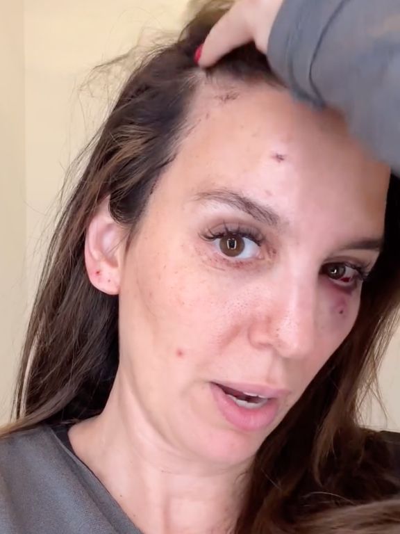 Christy Carlson Romano Shot in the Eye While Shooting Clay Pigeons for Husband’s Birthday