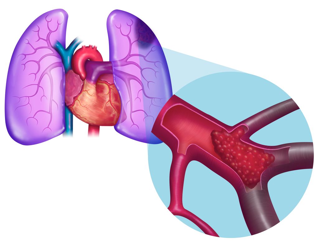 Pulmonary Embolism. A Blood Clot Arrives At The Heart And Is Sent, With The Blood Flow, Towards The Lungs. Being Too Big To Circulate Into The Blood Vessels, Narrower And Narrower, Up To The Pulmonary Alveoles, This Clot Will Obstruct Certain Pulmonary Arterioles, Provoking An Ischemia Then A Pulmonary Embolism. This Image Is Part Of A Series On Pulmonary Pathologies.