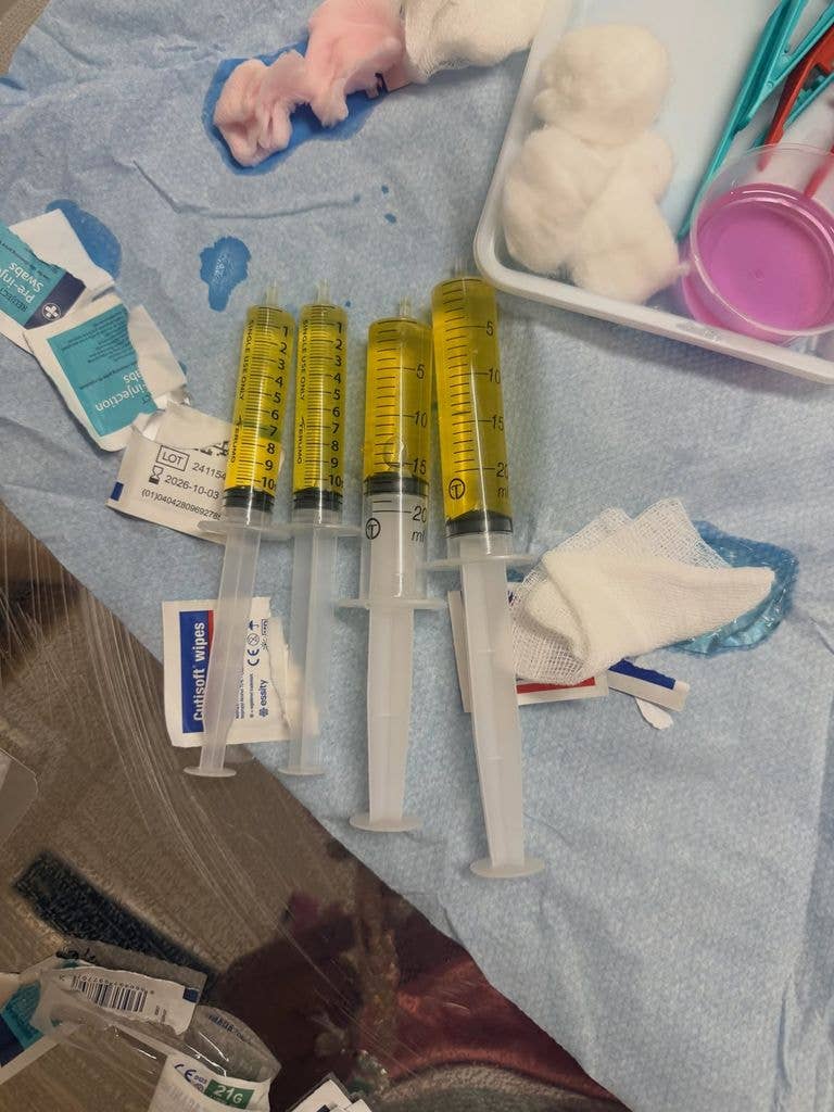 Fluid drained from Serena Williams' knee, shared via Instagram