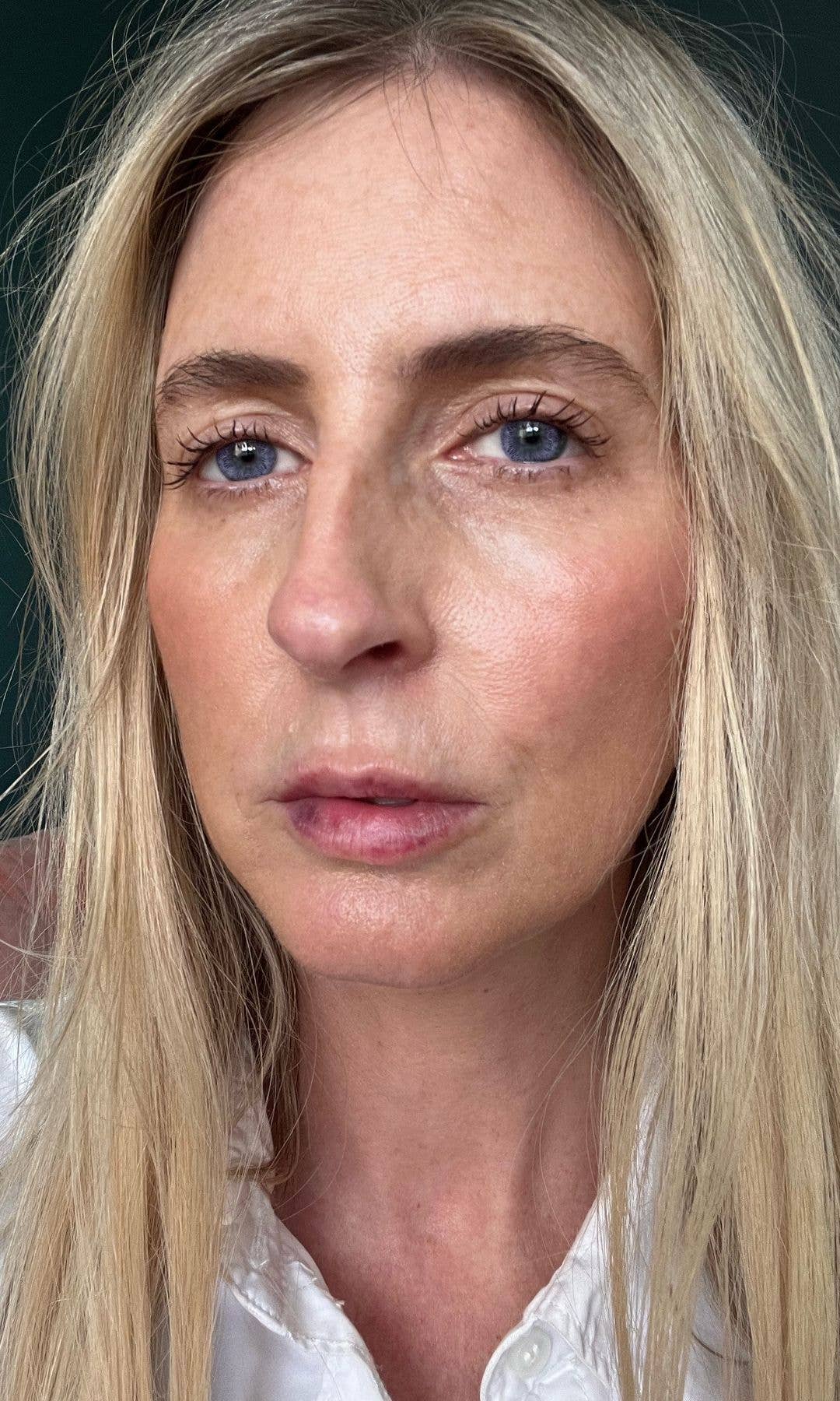 Charley 12 hours after her lip filler treatment